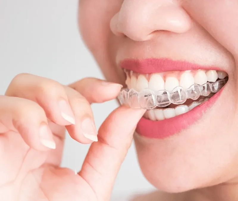 Clear Aligners